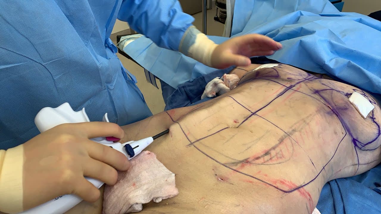 Watch a abdominal lipo for women lp procedure video