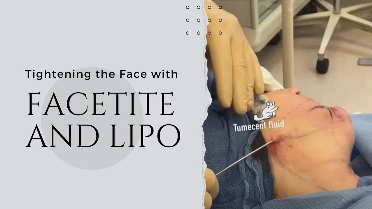Watch a face and neck lipo for men procedure video