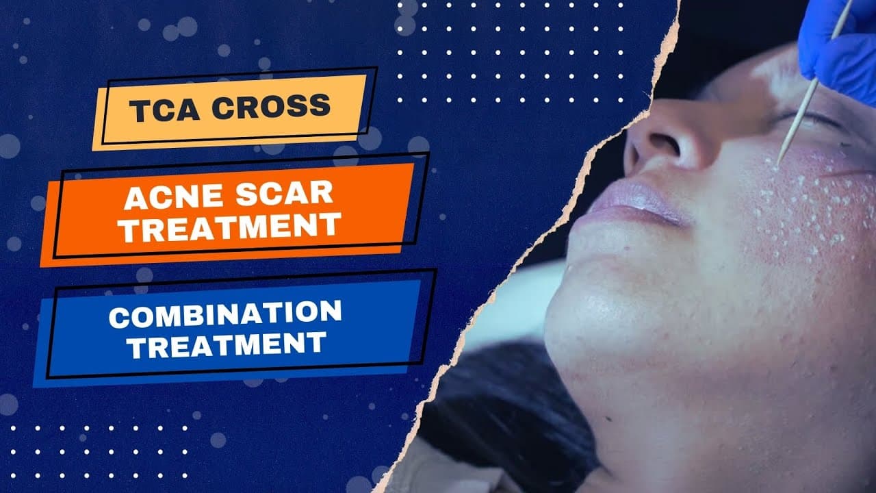 Acne Scar Treatments procedure video