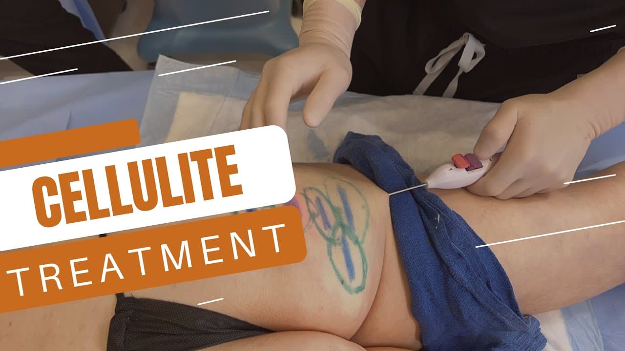 Watch a avéli procedure video