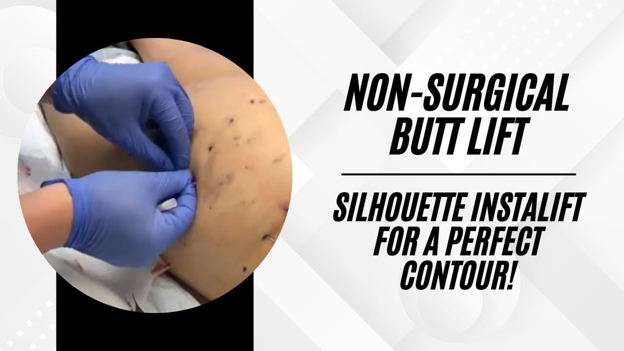 Cellfina procedure video