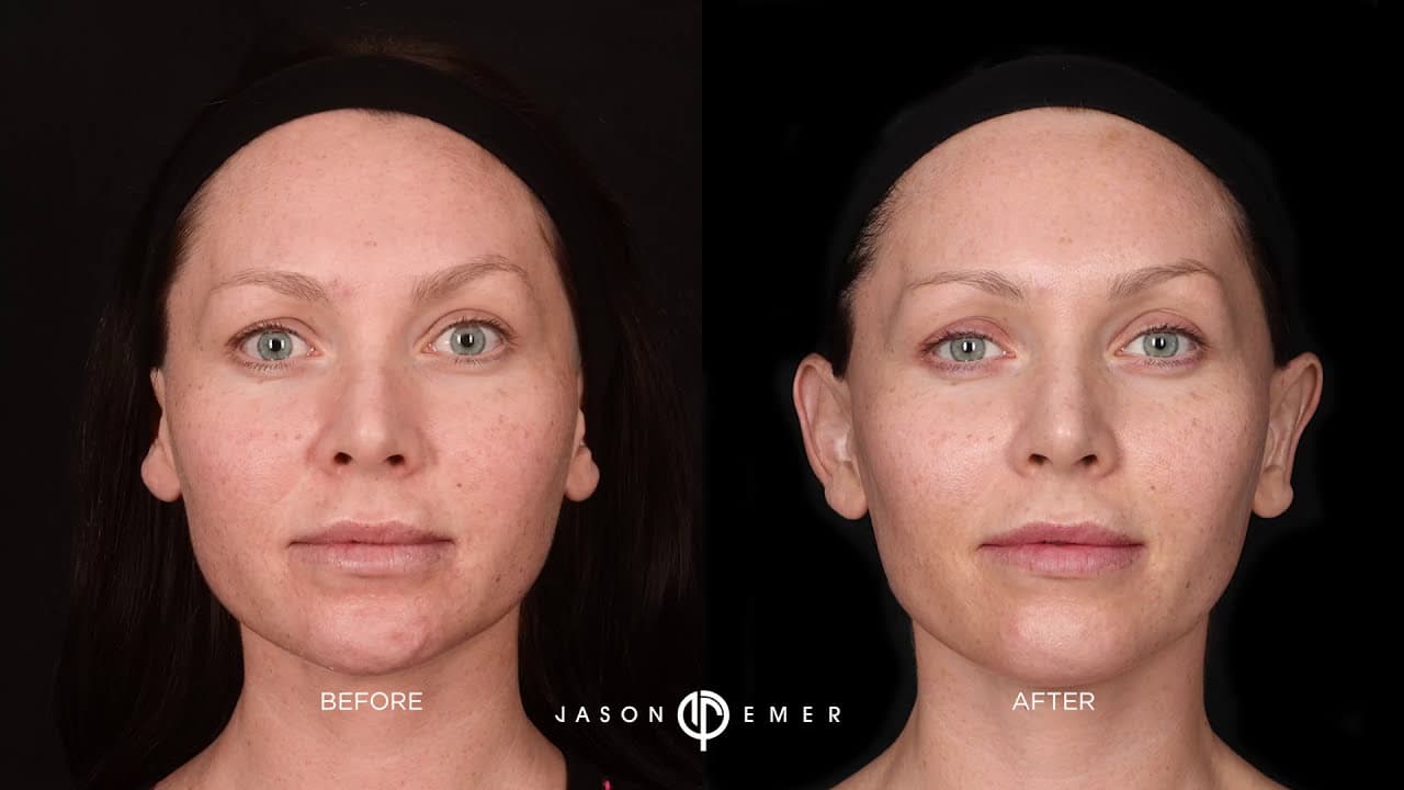 Watch a vampire facial procedure video