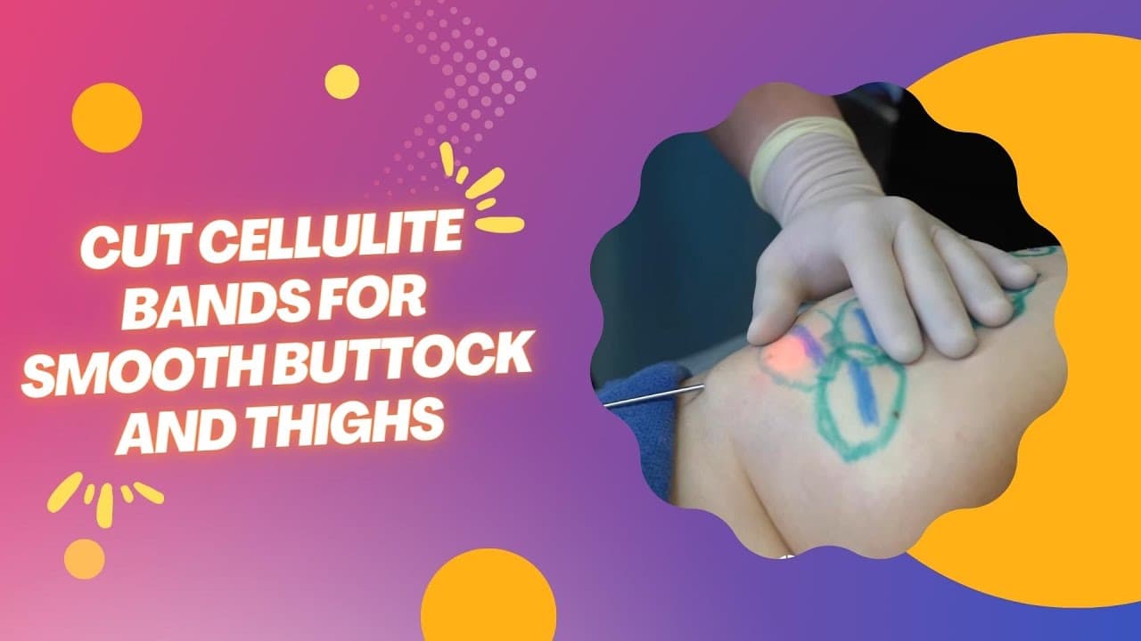 Watch a avéli procedure video