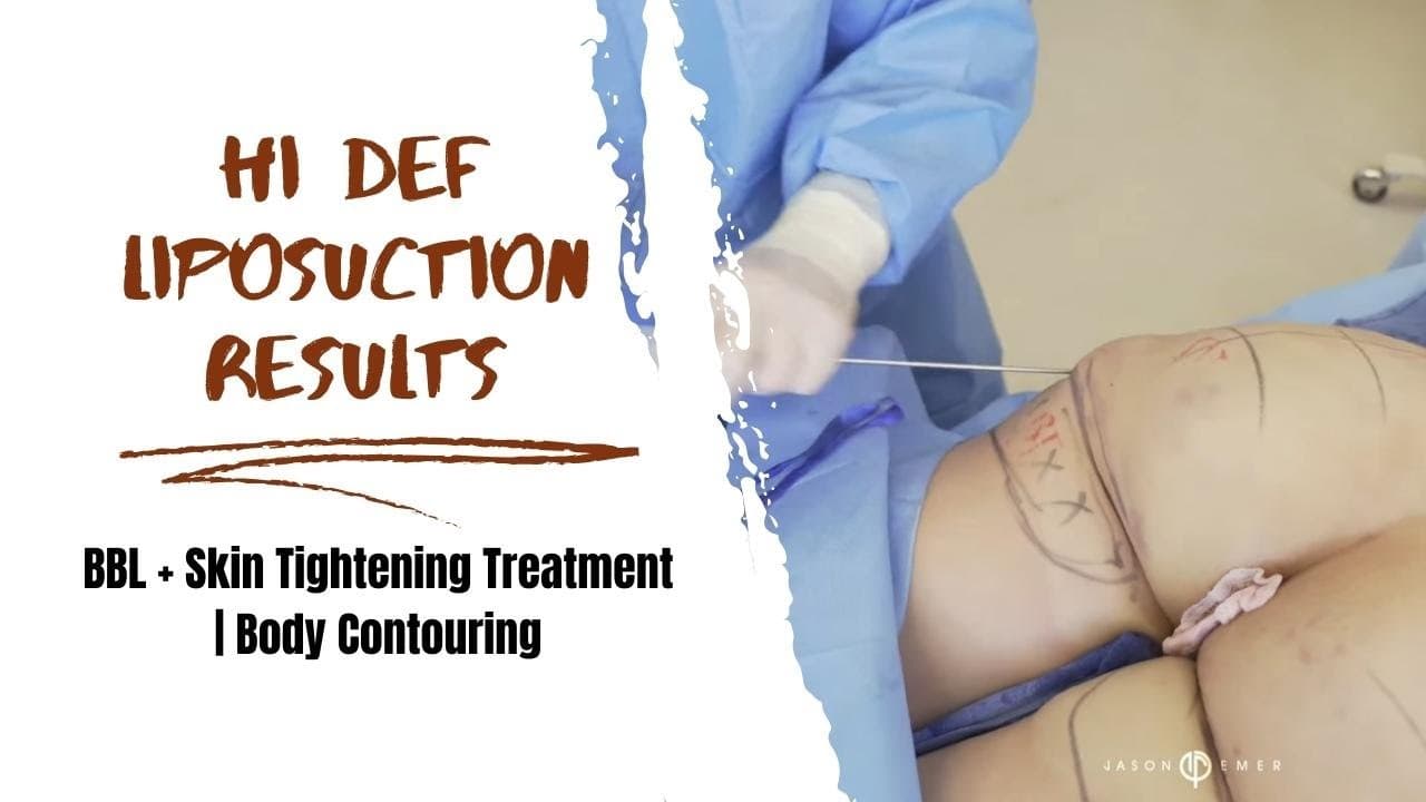 Watch a back lipo for women procedure video
