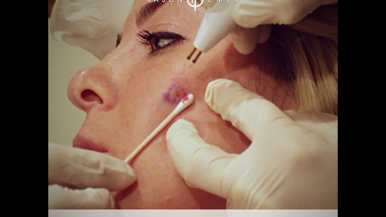 Watch a moles procedure video