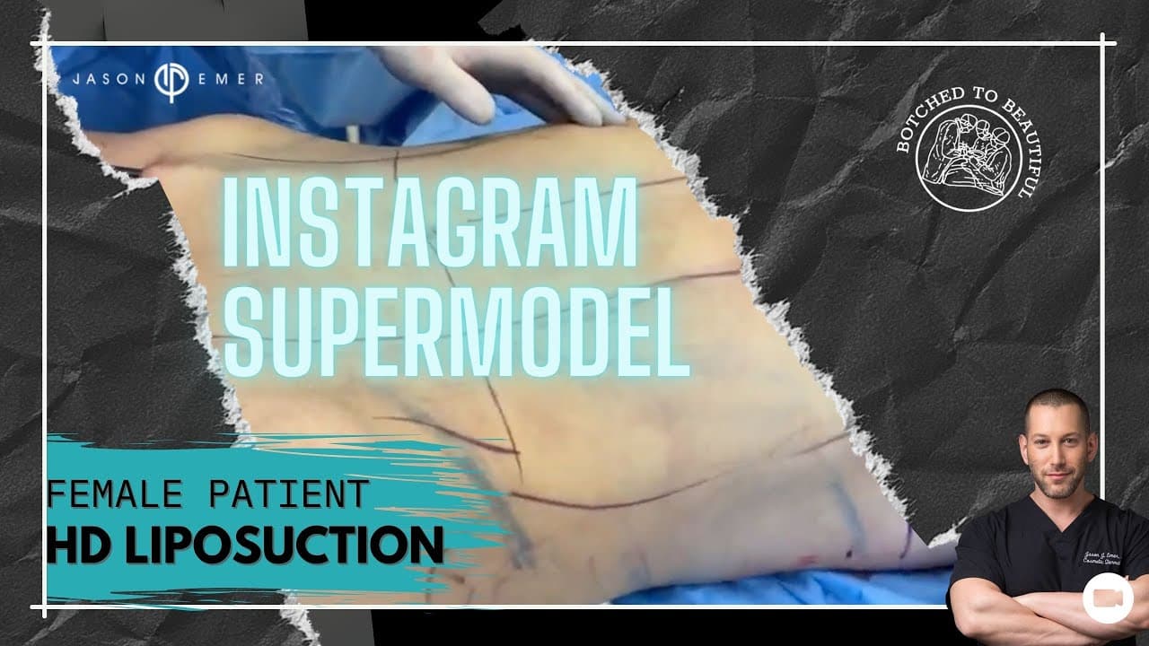 Watch a abdominal lipo for women lp procedure video