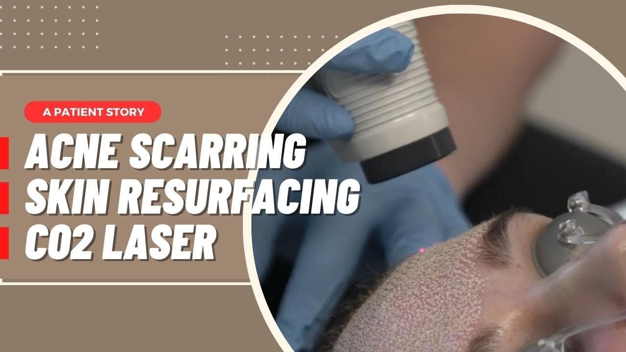 Watch a laser & rf skin resurfacing procedure video