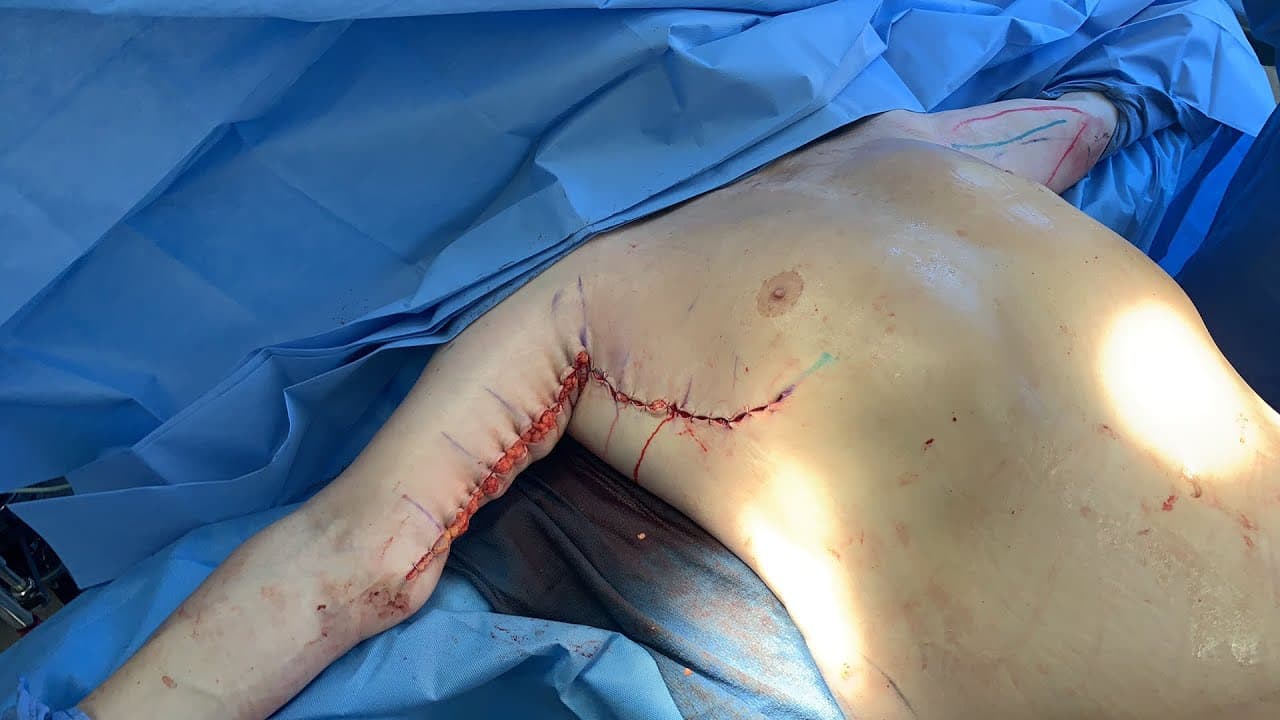 Watch a arm lift & tightening  for men procedure video