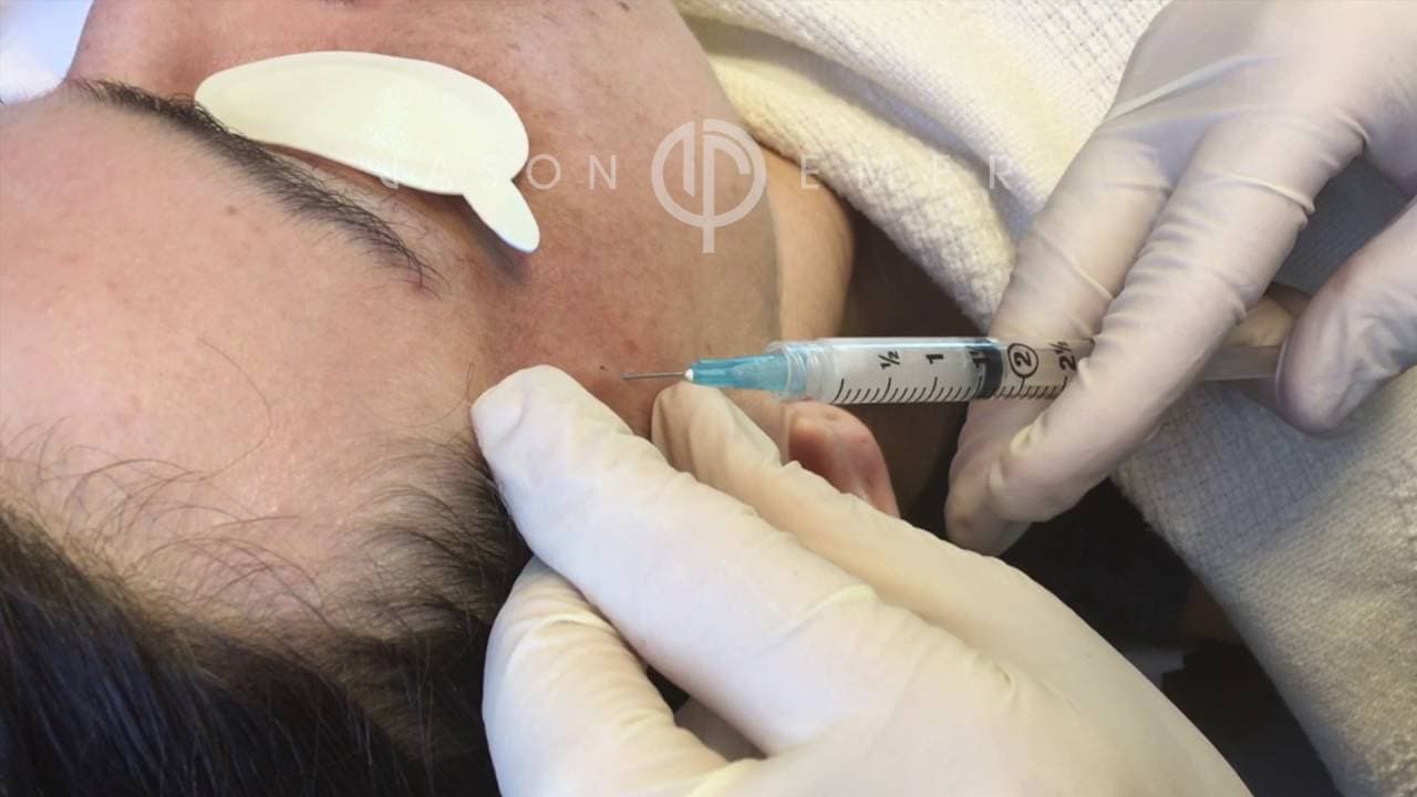 Watch a dr. jason emer: sculptra procedure video