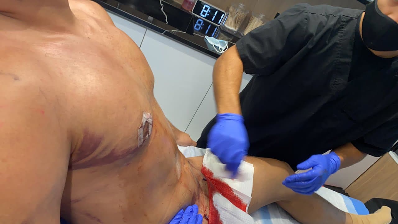 Watch a abdominal lipo for men lp procedure video