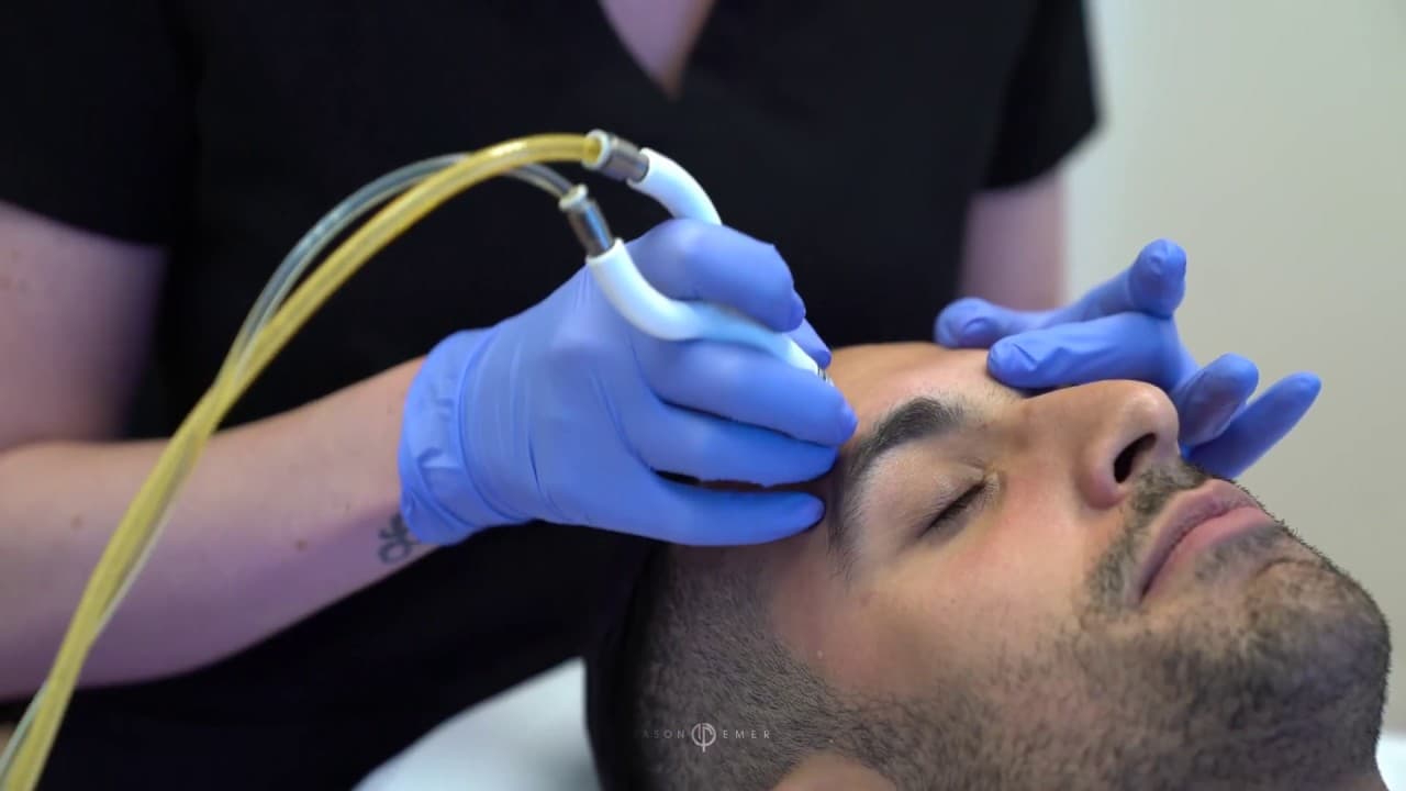 Watch a dermaplaning procedure video
