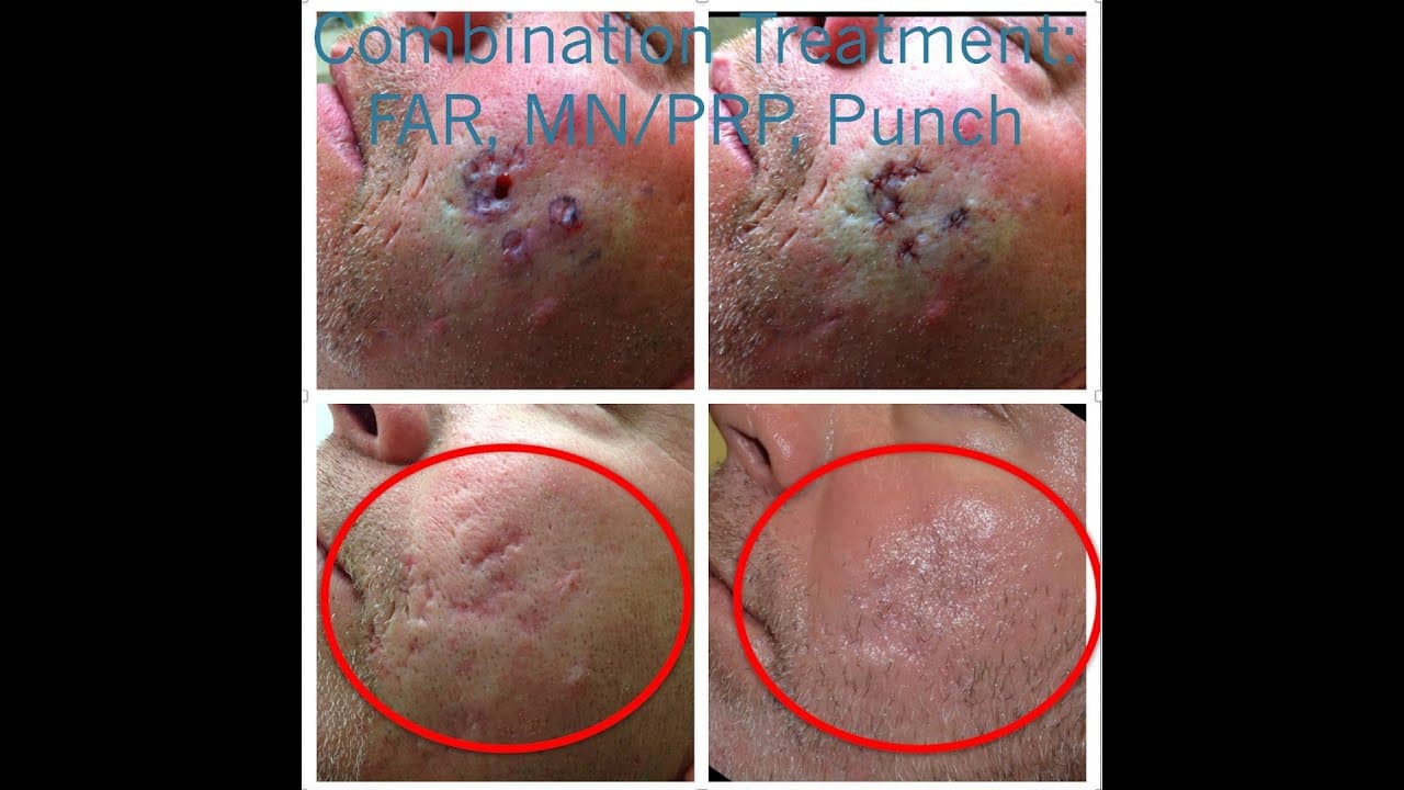 Acne Scar Treatments procedure video