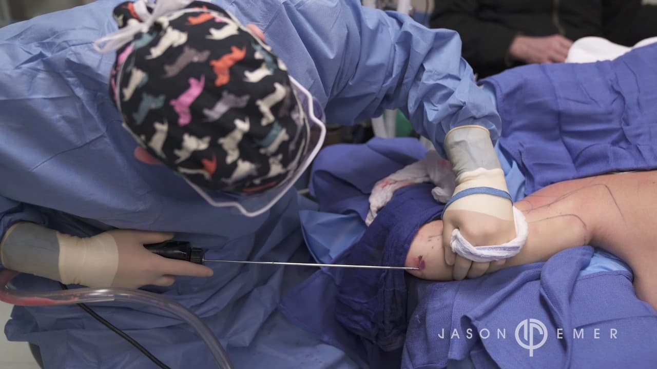 Watch a arm liposuction lp procedure video