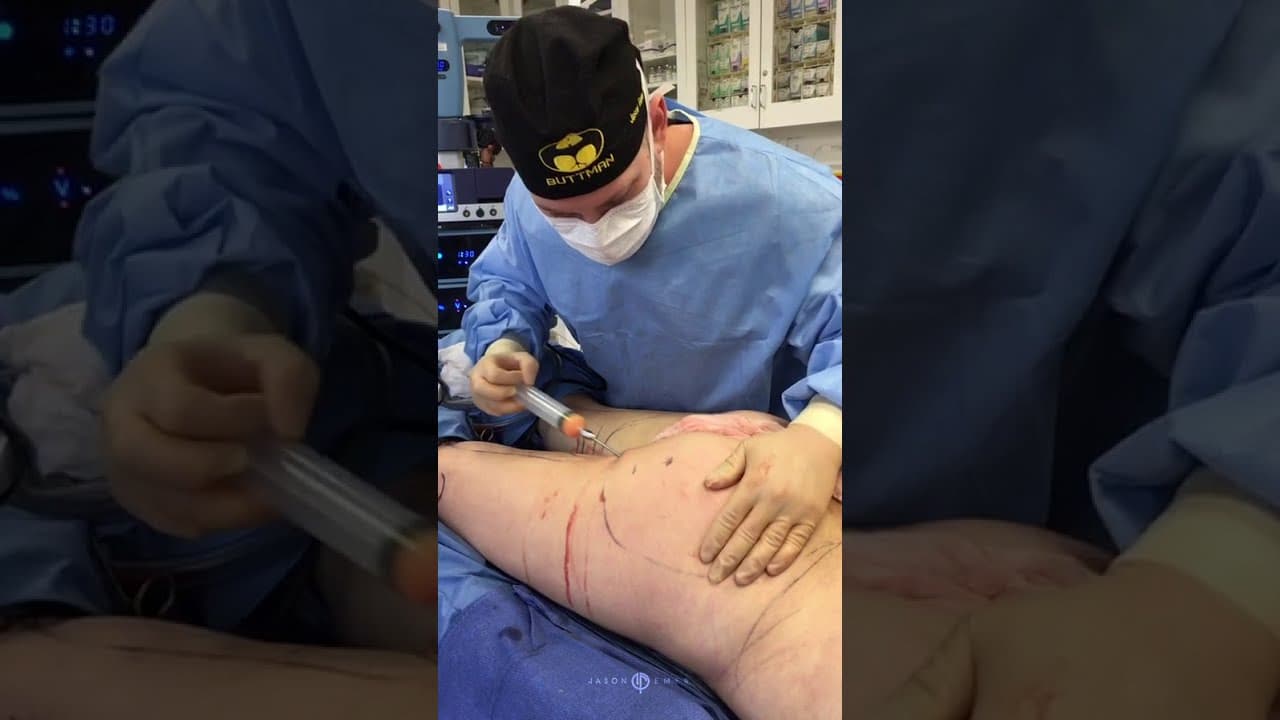 Watch a autologous fat grafting provides permanent volumization, shaping, sculpting, and muscular definition enhancements procedure video