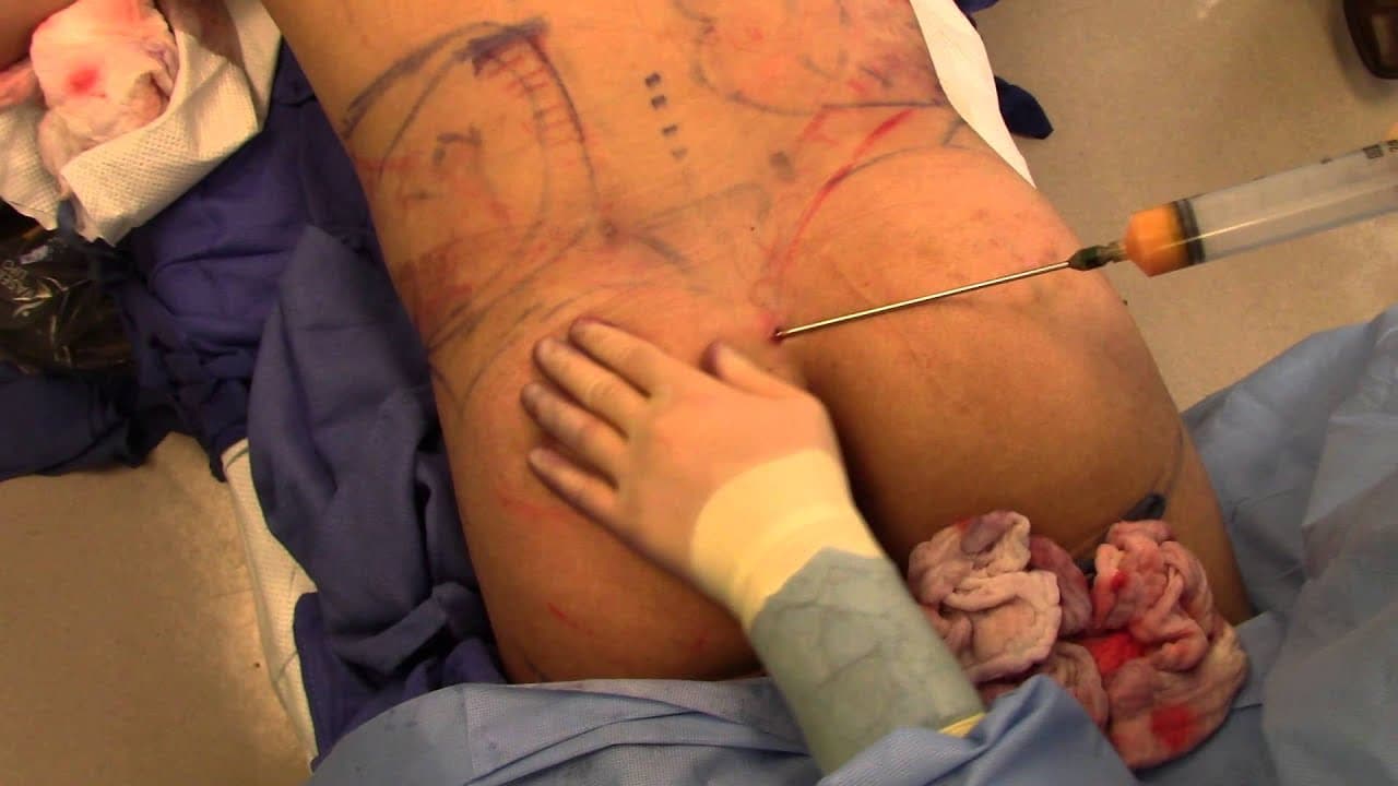 Watch a back lipo for men procedure video