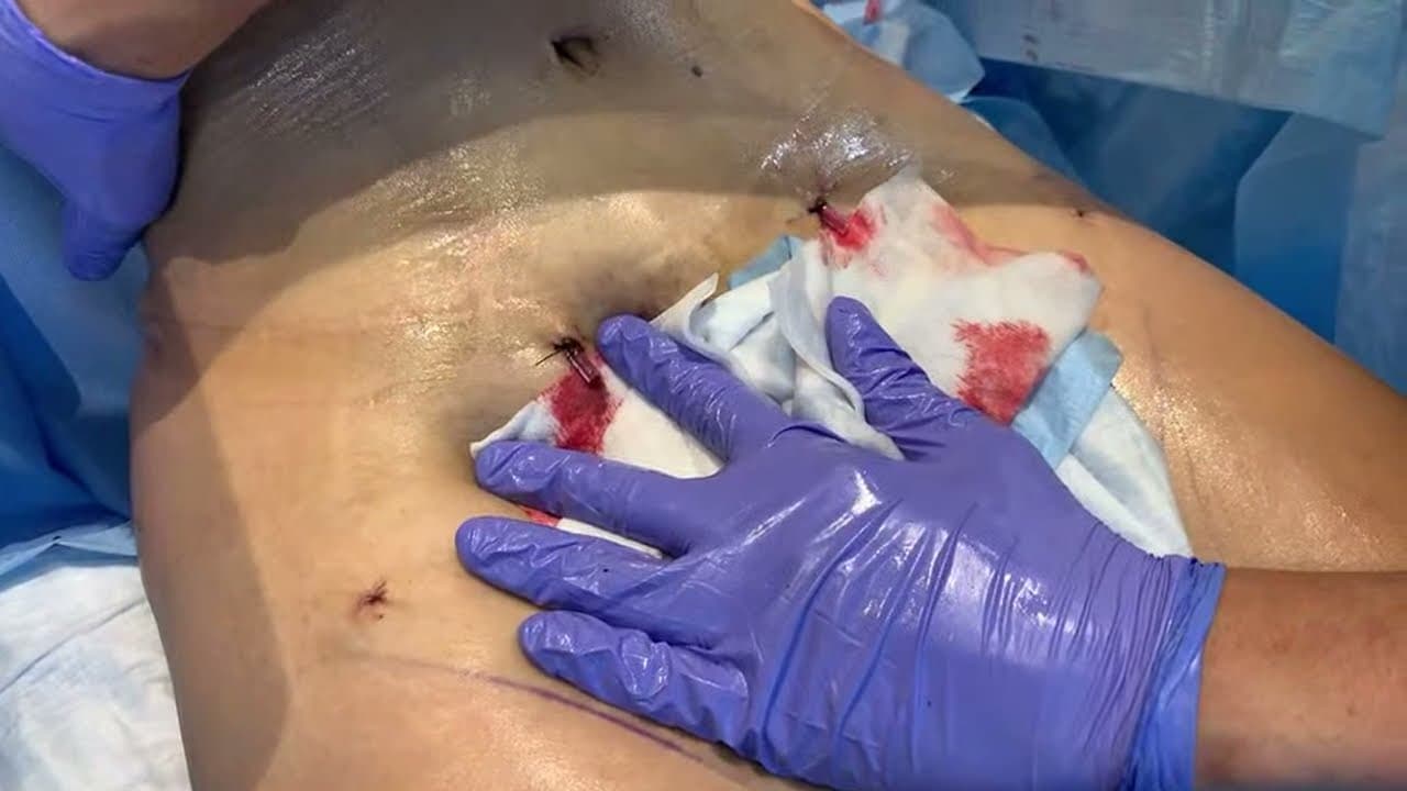 Watch a abdominal lipo for women lp procedure video