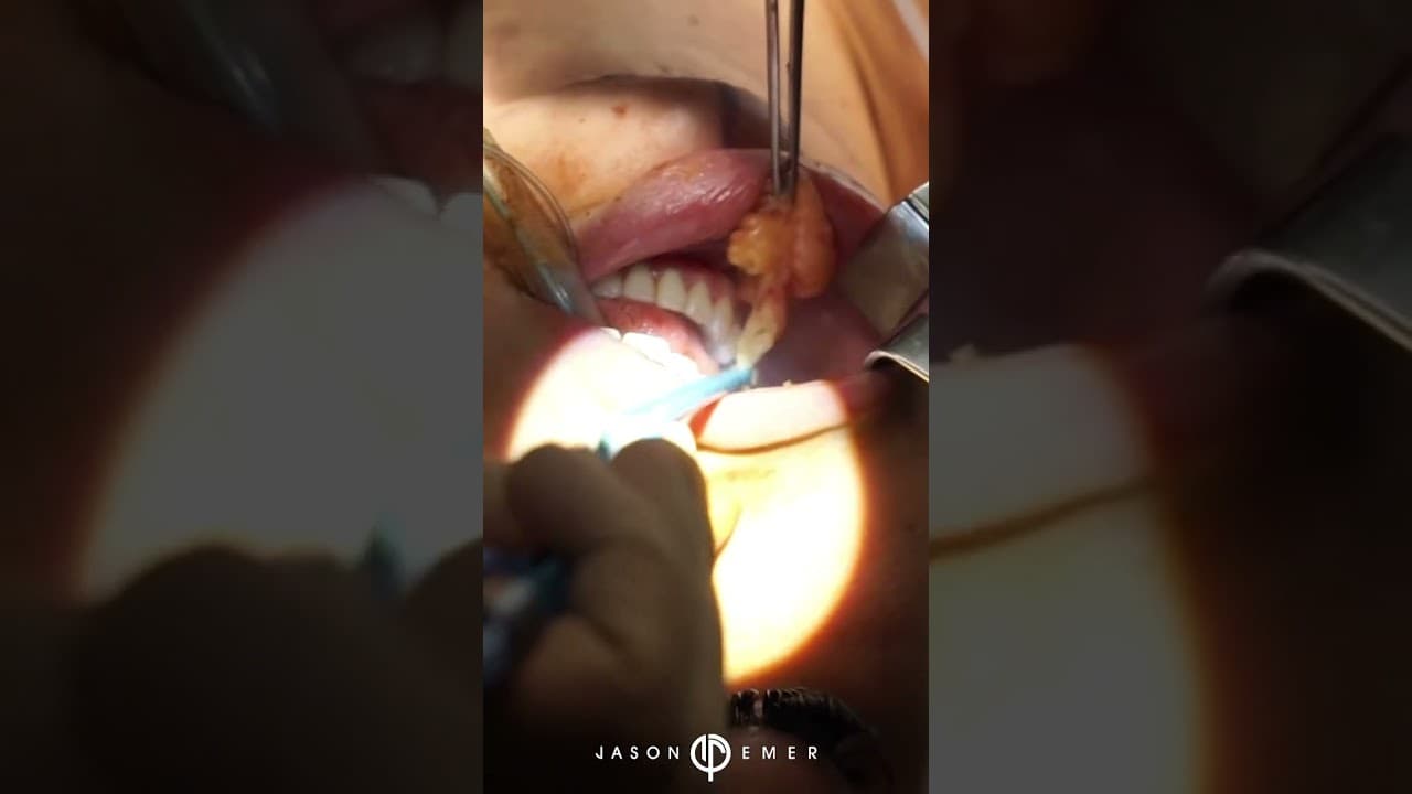 Watch a chin implants procedure video