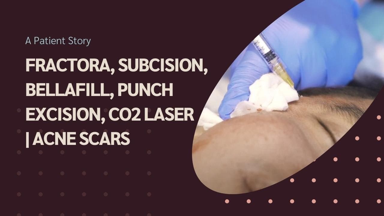 Acne Scar Treatments procedure video