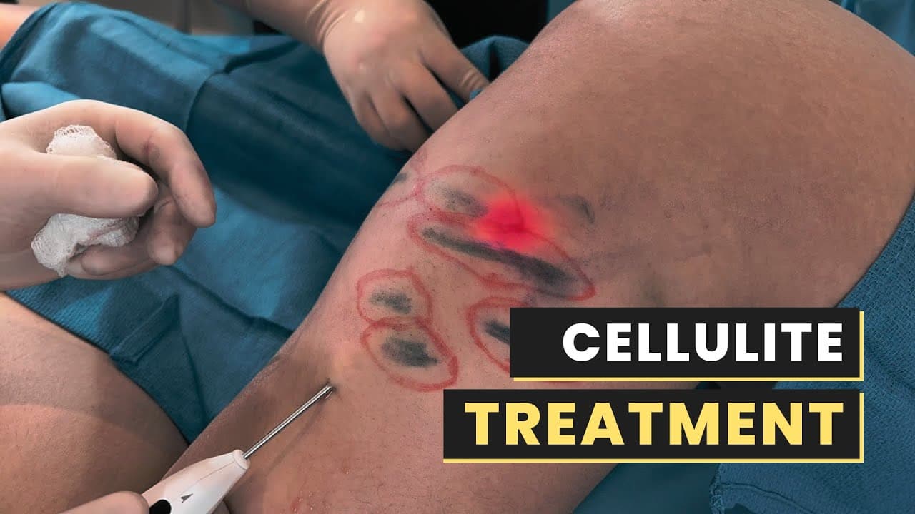 Watch a abdominal etching procedure video