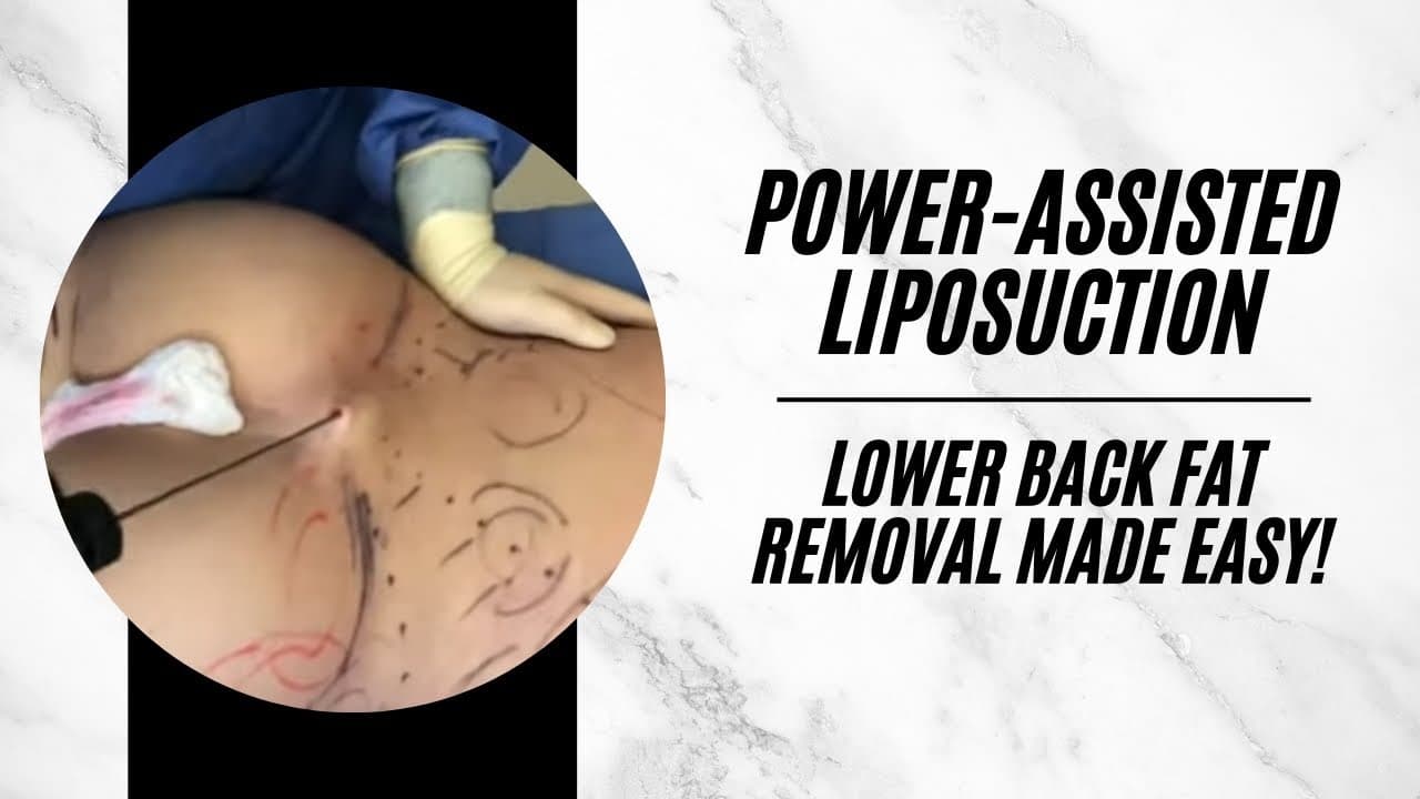 Watch a back lipo for women procedure video