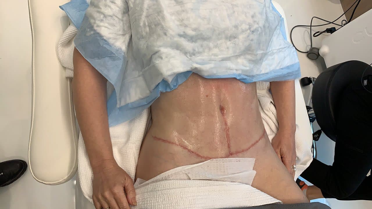Patient story video 2