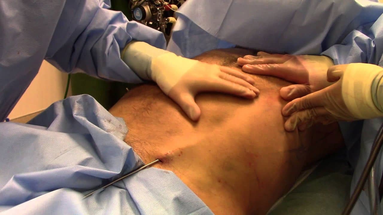 Watch a abdominal etching procedure video