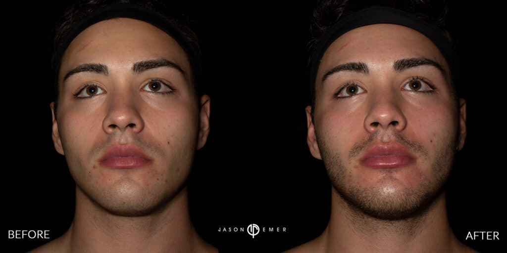 LIP FILLER MALE GALLERY