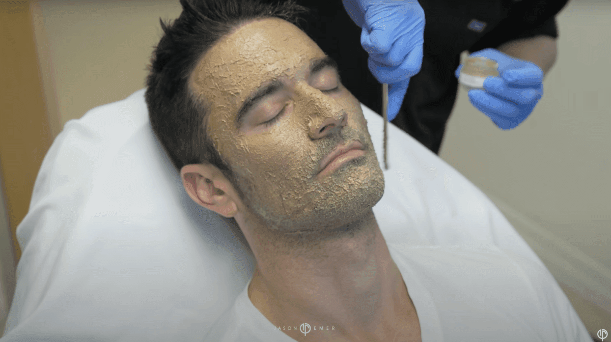 Cosmelan peel result targeting melasma at Dr. Jason Emer's practice