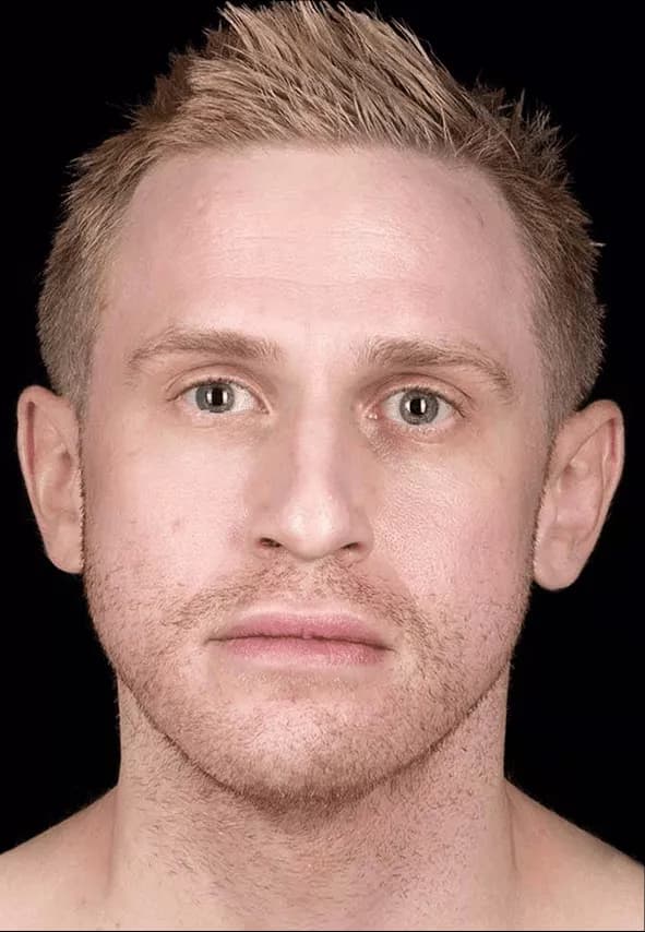 Male acne scarring — facial redness reference