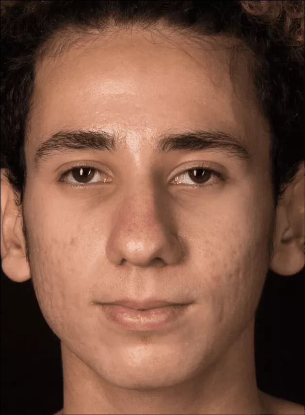 Male atrophic scar reference
