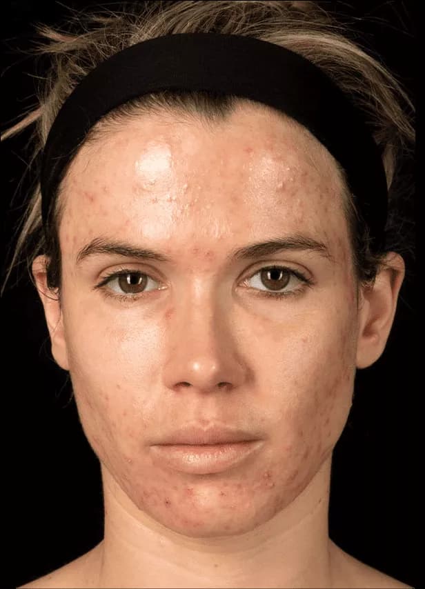 Female ice pick scar reference