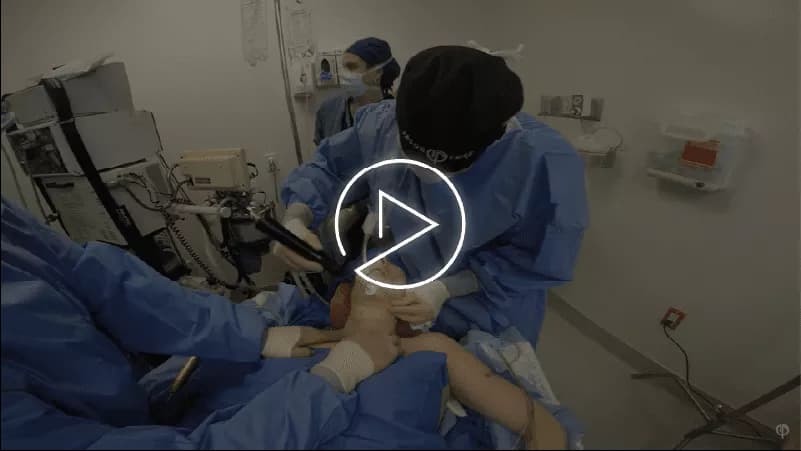 FACE AND NECK LIPO FOR MEN
