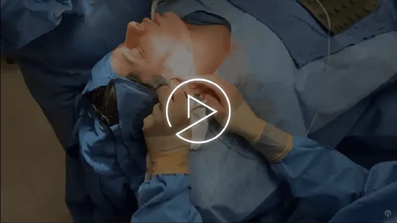 Deep Neck Lift