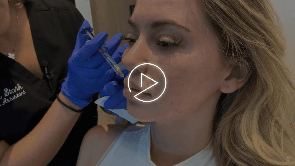 Surgical lip lift result