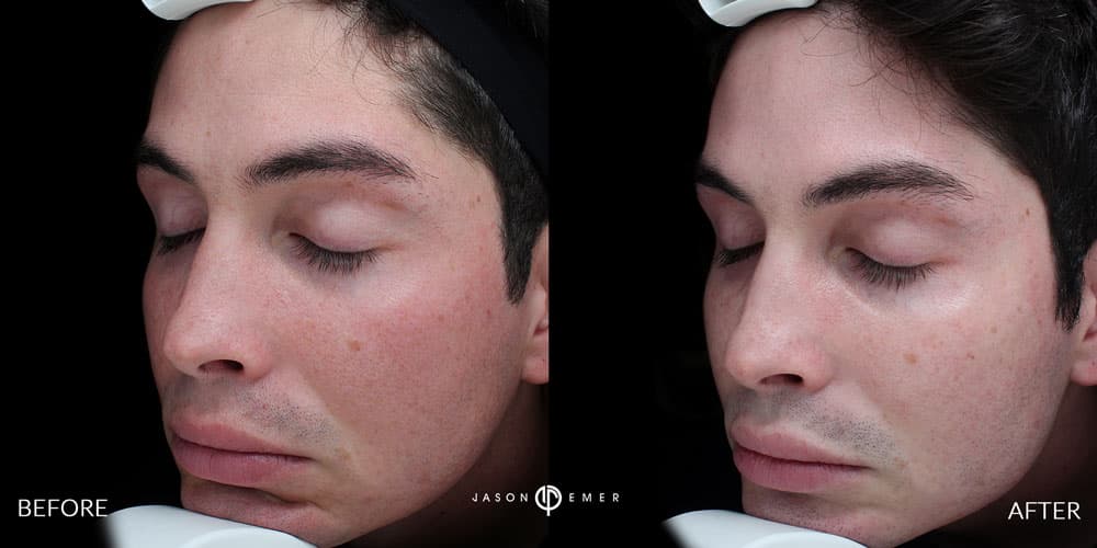 Male-Acne-Scar-treatment-Los-Angeles-1