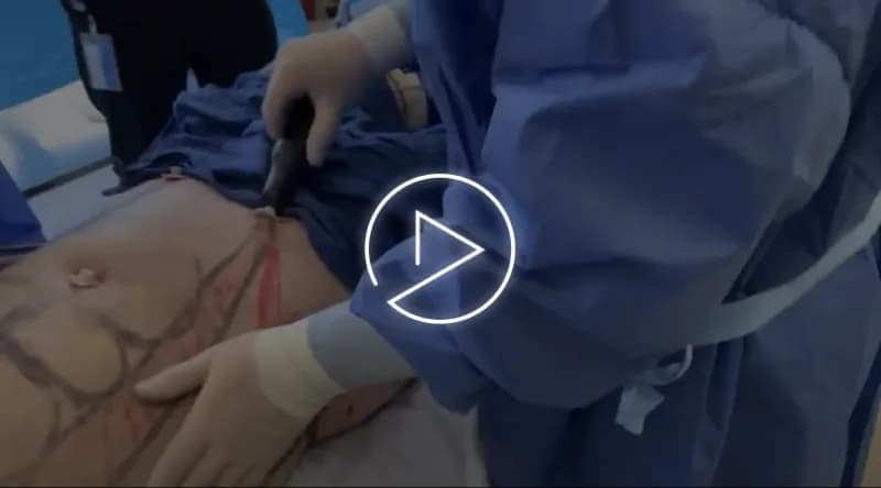 Paradoxical Hyperplasia from Coolsculpting before and after by Dr. Jason Emer in Beverly Hills