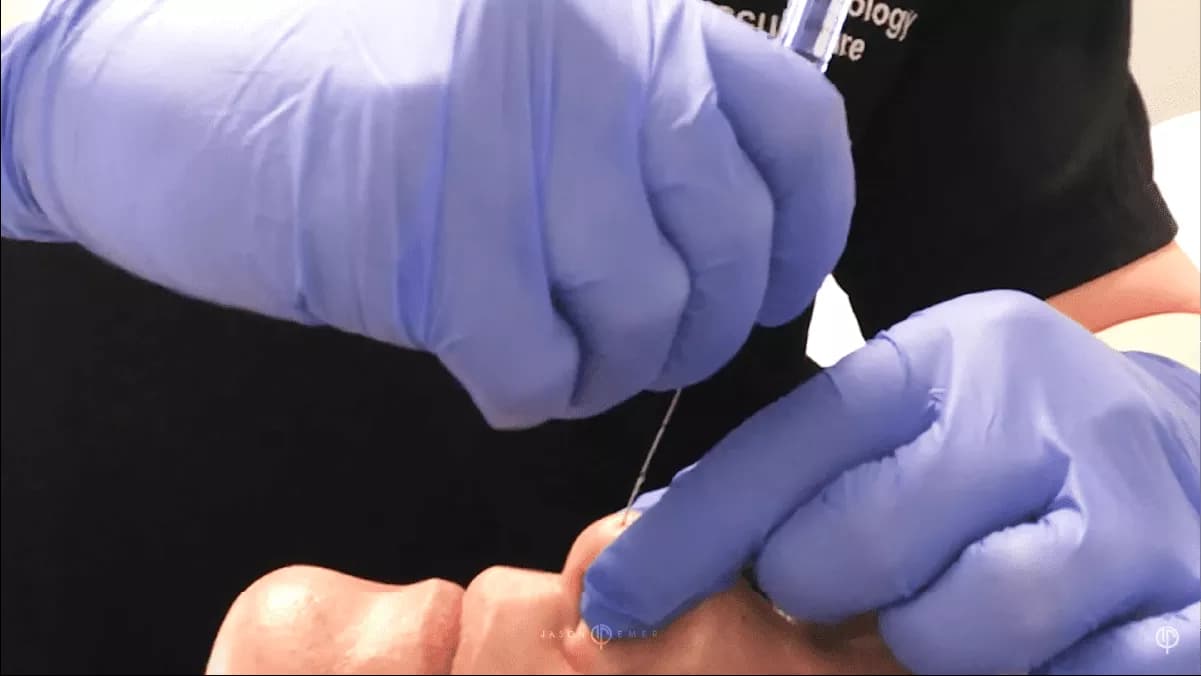 Functional rhinoplasty result