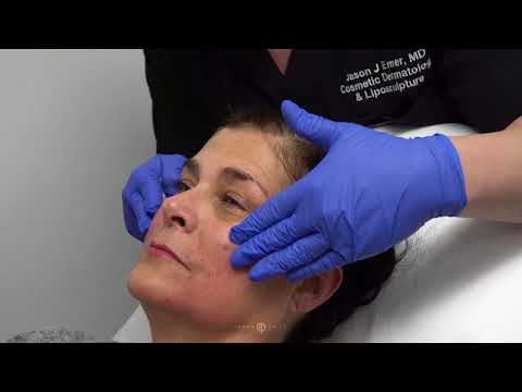 FEMALE FACIAL SCULPTING OF THE CHEEKS, Cosmetic Dermatologist Dr. Jason Emer