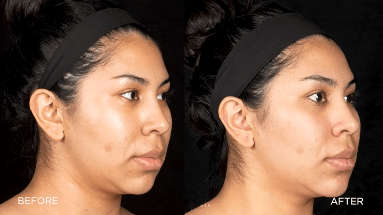 COUNTOURED FACE, Cosmetic Dermatologist Dr. Jason Emer