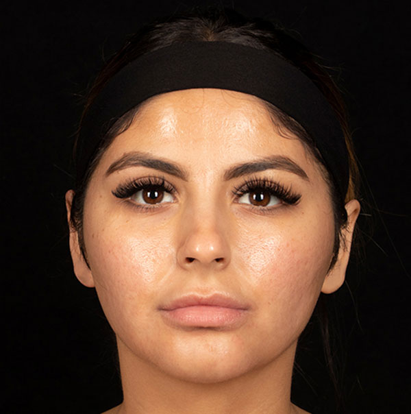 Female Face countouring skin damage and acne scarring after treatment| Board-Certified Dermatologist | Cosmetic Surgeon | Dr. Jason Emer MD | | Beverly Hills, CA