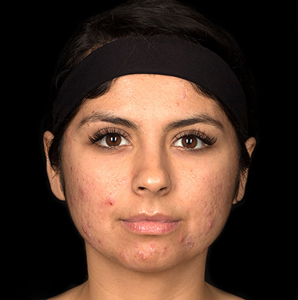 Female Face countouring skin damage and acne scarring before treatment| Board-Certified Dermatologist | Cosmetic Surgeon | Dr. Jason Emer MD | | Beverly Hills, CA