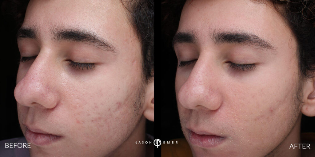 Acne scar best before and after los angeles beverly hills