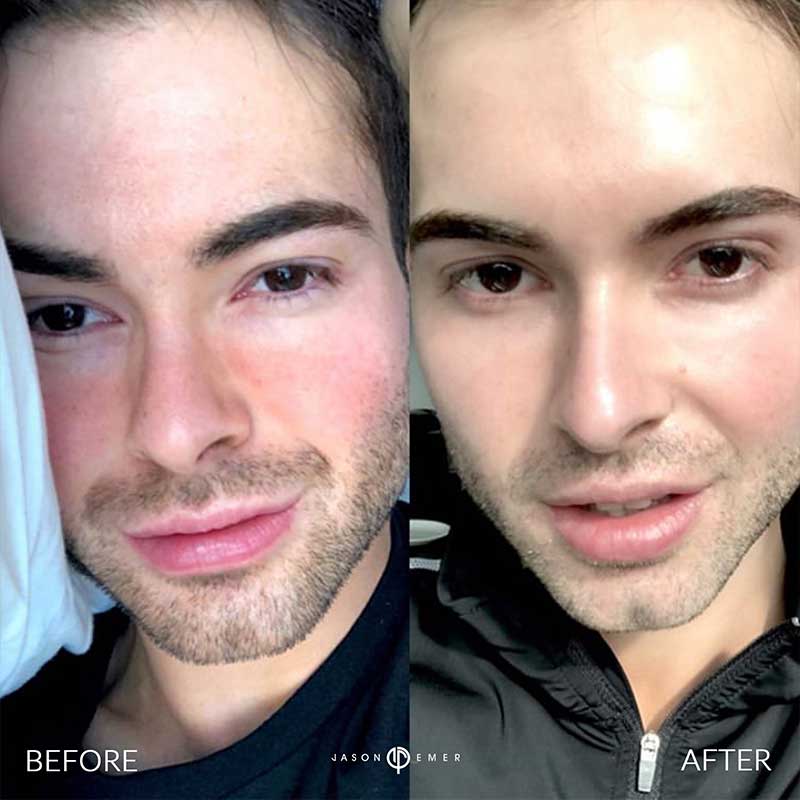 Aerify Complexion Kit | Before and After | Dr. Jason Emer MD | | Beverly Hills, CA