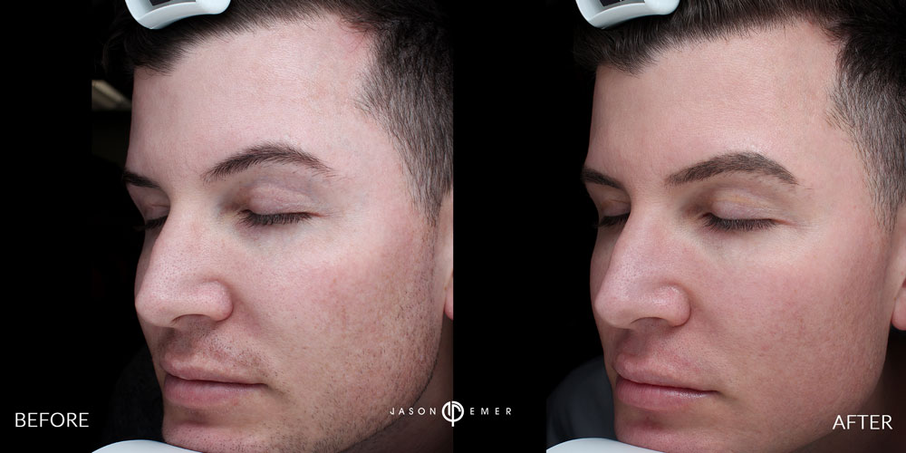 Male-Acne-Scar-Treatment-Before-and-After-Los-Angeles-2