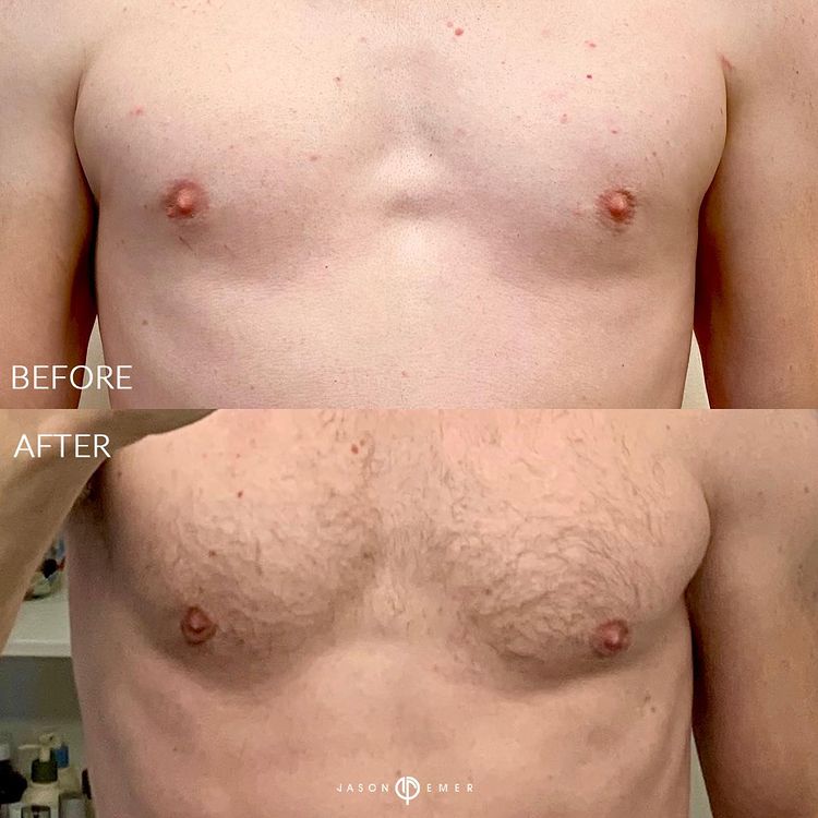 360 HD Lipo Beverly Hills Male Patient 7 - 2
