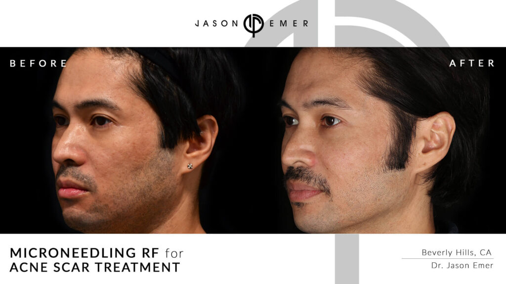 Microneedling for acne scar treatment | Before and After | Dr. Jason Emer MD | | Beverly Hills, CA