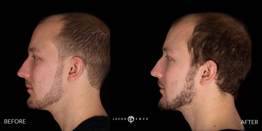 Microneedling for acne scar results | Before and After | Dr. Jason Emer MD | | Beverly Hills, CA