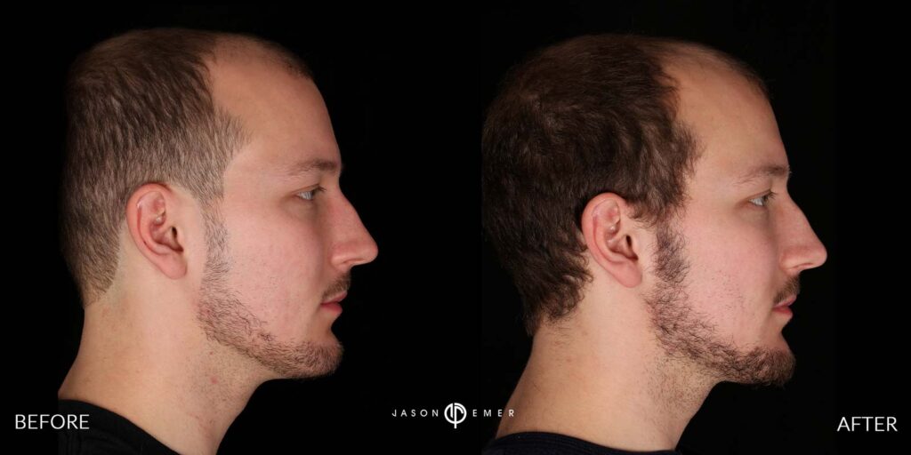 Microneedling for acne scar results | Before and After | Dr. Jason Emer MD | | Beverly Hills, CA