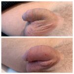 HA FILLERS TO PENIS FIRST TREATMENT