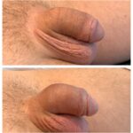 HA FILLERS TO PENIS FIRST TREATMENT